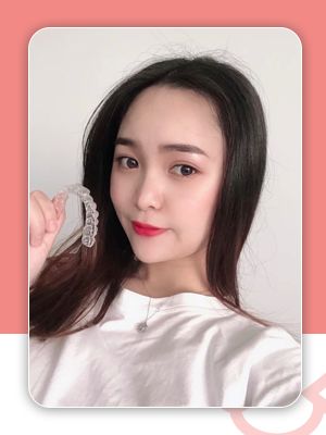 牙齿缝隙大隐形牙套矫正前后对比,牙齿前突隐形牙套矫正的全过程