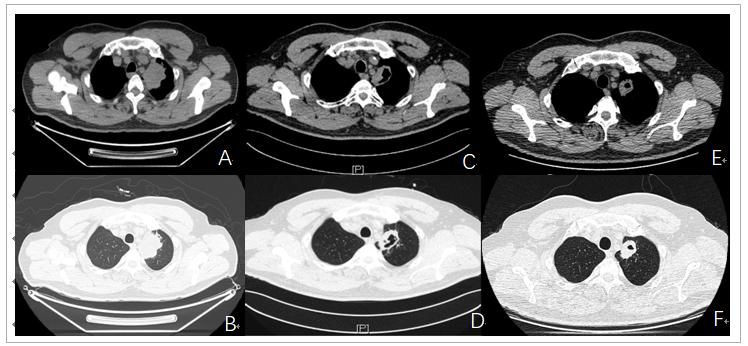 免疫治疗相关性肺炎处理,免疫治疗肺炎新进展