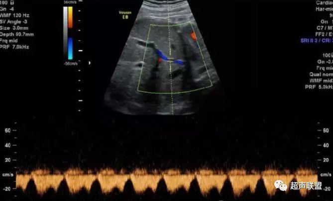 胎儿宫内窘迫通过什么检查出来的,胎儿宫内缺氧的超声视频