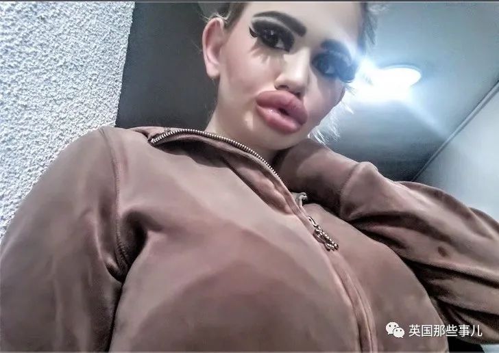 27次手术丰唇,女子疯狂整容100次成芭比疯狂丰唇