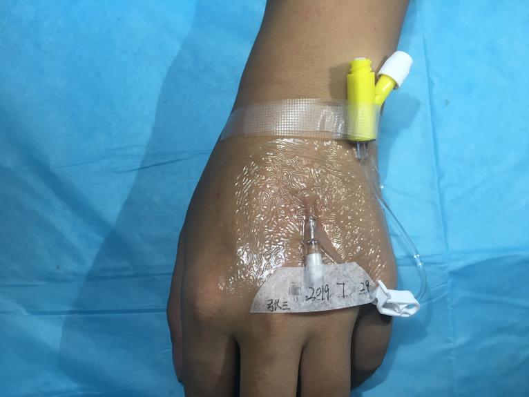 经验分享留置针经常堵管怎么办,留置场所经验分享