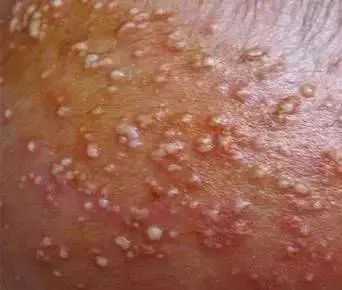 夏天预防治疗宝宝痱子的小方法,婴儿夏天防痱子用什么