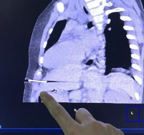 小孩子玩射钉枪打伤姐姐,射钉枪打到小孩身上