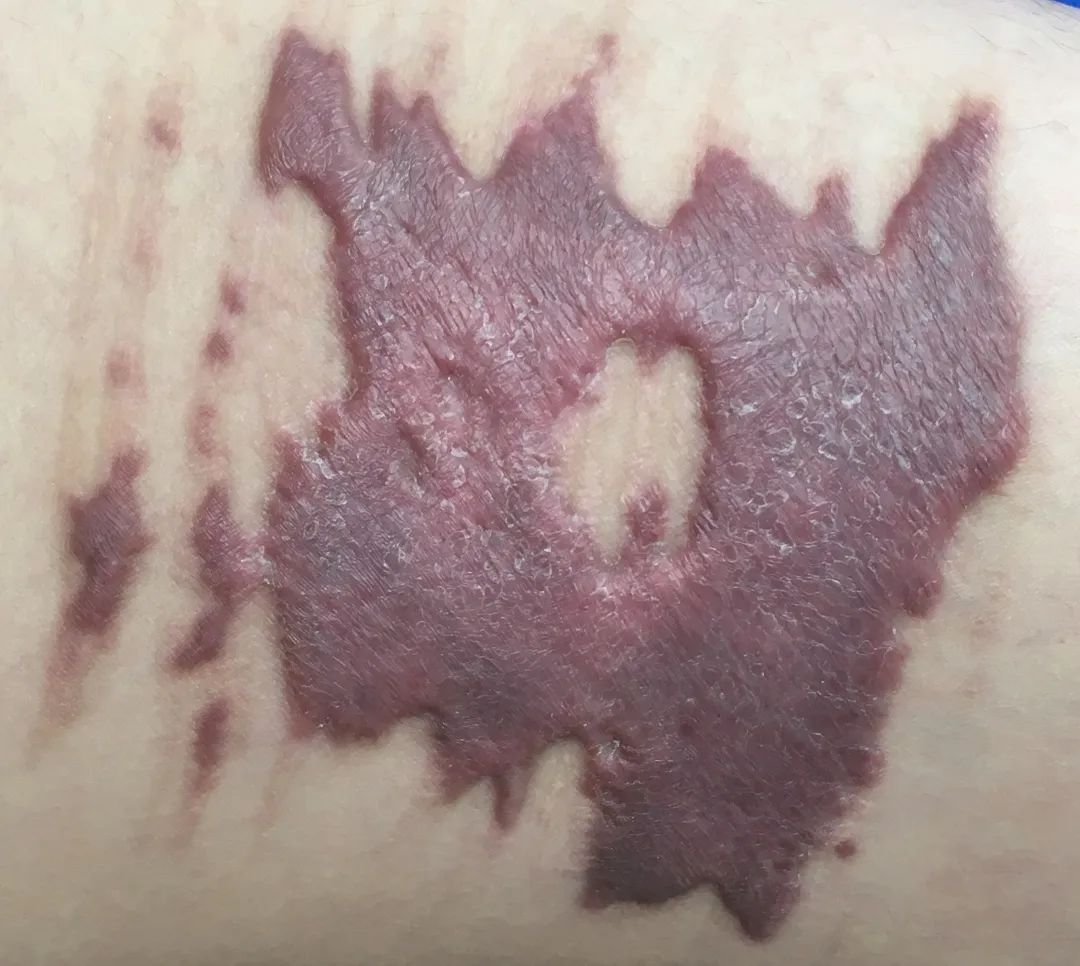 瘢痕体质留疤了怎么办,只有开刀才长疤是瘢痕体质吗