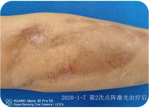 瘢痕体质留疤了怎么办,只有开刀才长疤是瘢痕体质吗