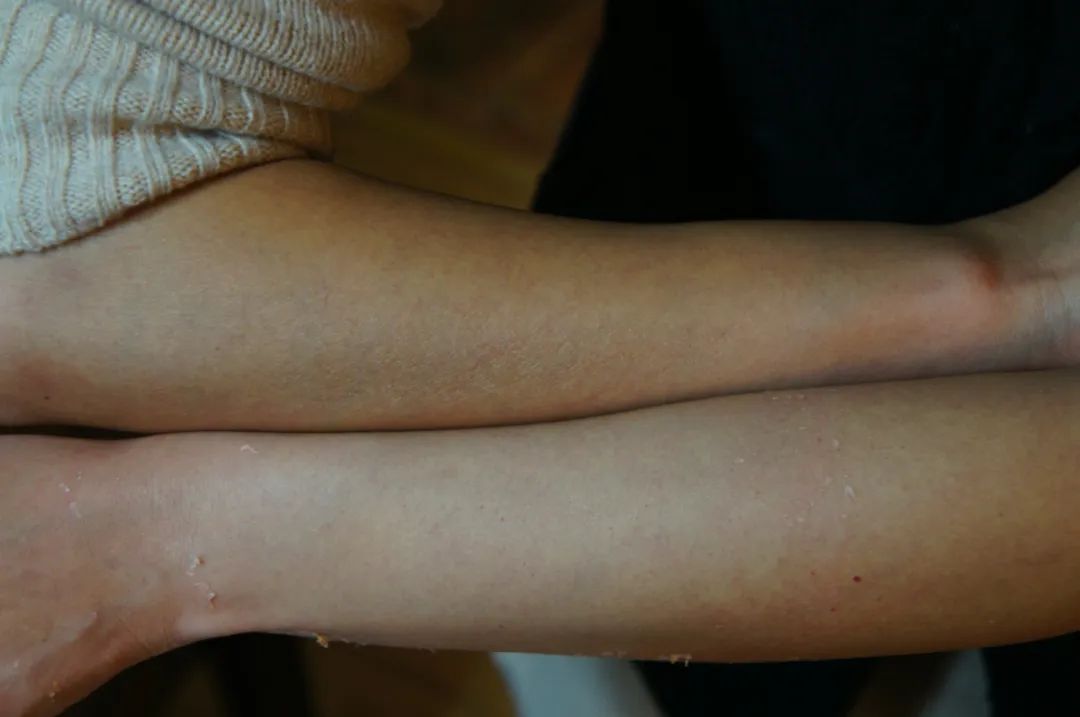 荐物|初夏将至，油皮如何去除黑白头？