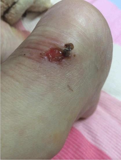 穿鞋磨脚的解决方法,穿鞋磨脚后跟外侧改善方法