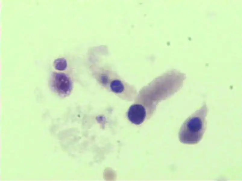 尿液有形成分检查,尿液中检测到的有形成分有哪些