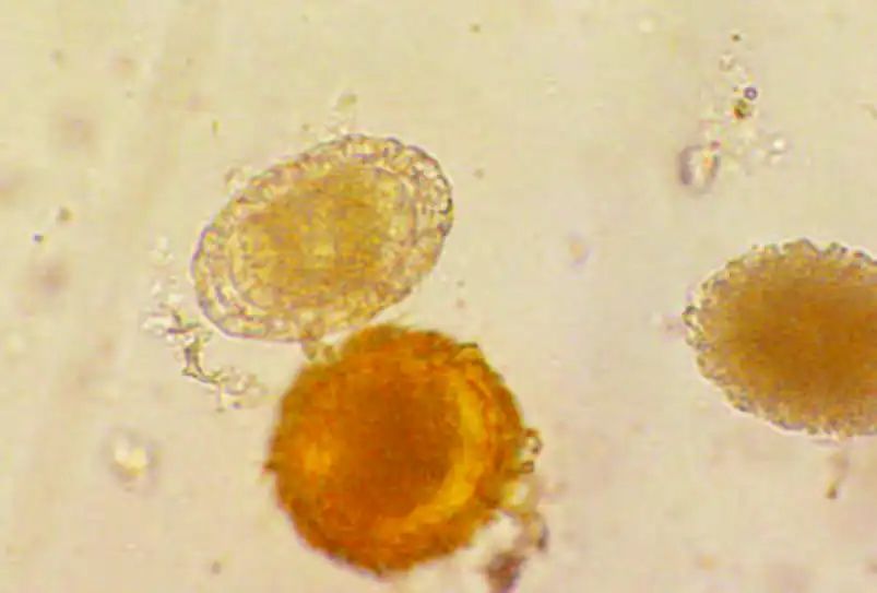 尿液有形成分检查,尿液中检测到的有形成分有哪些