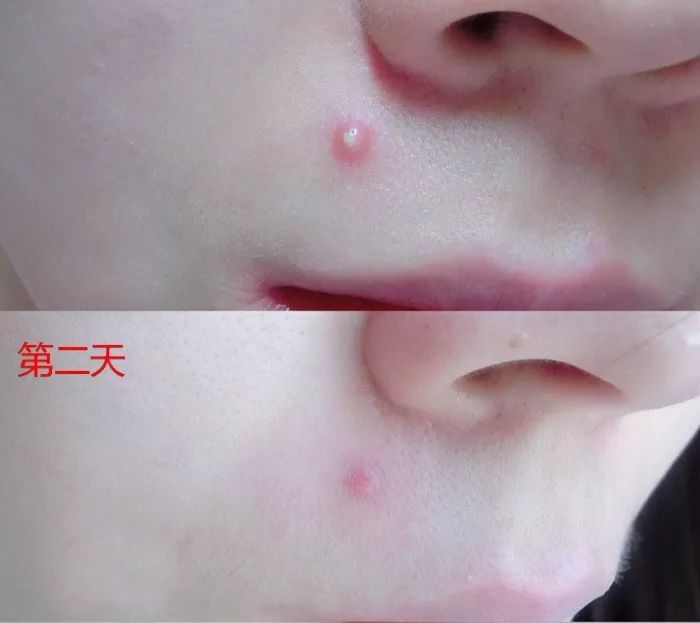 用什么洗脸抑制螨虫生长,用什么洗脸可以抑制螨虫生长