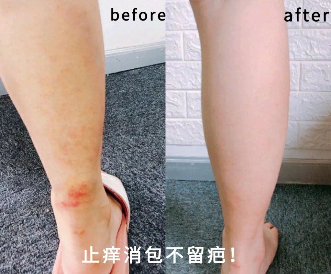 1罐搞定一整夏！20秒止痒消肿，让蚊虫再无嚣张机会