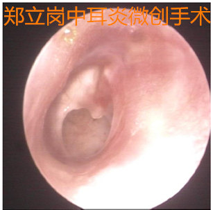 耳朵流脓听力下降需要做手术吗,耳朵流脓不管它会好吗
