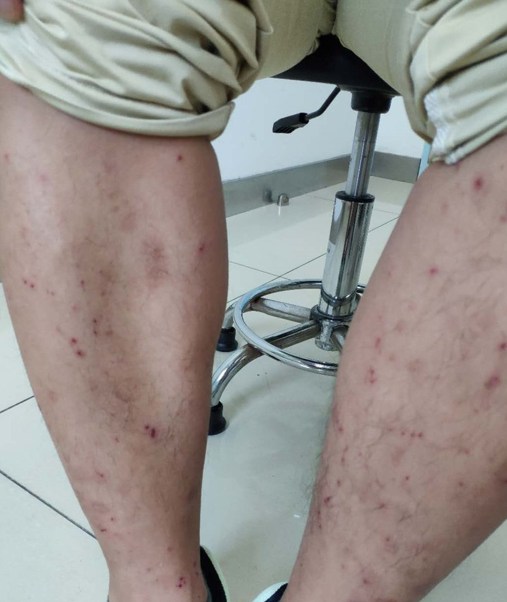 25岁女孩醒来身上起红点,25岁女子全身瘙痒