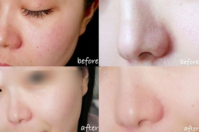 清洁毛孔黑头粉刺吸尘器,doco超微小气泡毛孔吸尘器直播