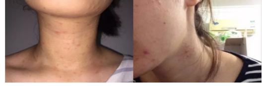 鼻头痘痘挤出来的白色物质是什么,团状红痘痘