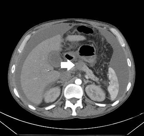 胰腺炎治疗过程中出现腹水,胰腺炎引起肝腹水怎么办