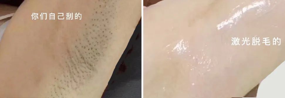 399元永久脱毛,618精选脱毛好物