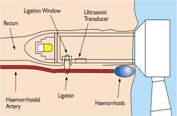 超声多普勒痔动脉结扎术利弊,超声刀治疗痔疮还需要内扎吗