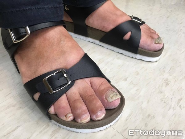 夏季易霉菌感染！药师曝类固醇止痒恐长肉芽　4项预防细节超重要