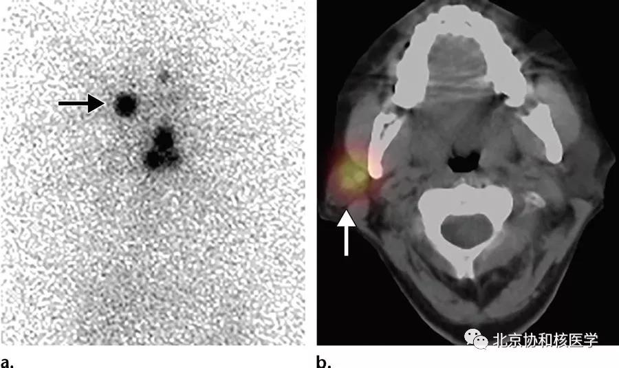 碘扫描最坏的结果,放射性核素扫描可以鉴别诊断吗