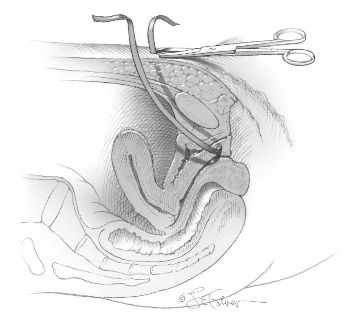 出现压力性尿失禁怎么解决,因为压力大尿频怎么办