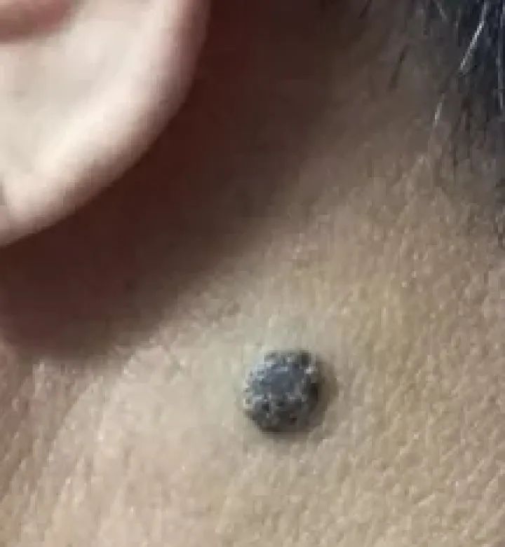 黑痣癌变的痣会很大吗,黑痣癌变一般是一个痣还是好多