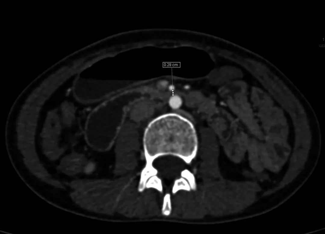 肠系膜上动脉综合征治疗,肠系膜上动脉综合征发生在哪