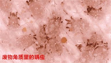 老是感觉身上痒痒的是螨虫吗,总觉得身上痒有虫子爬怎么回事