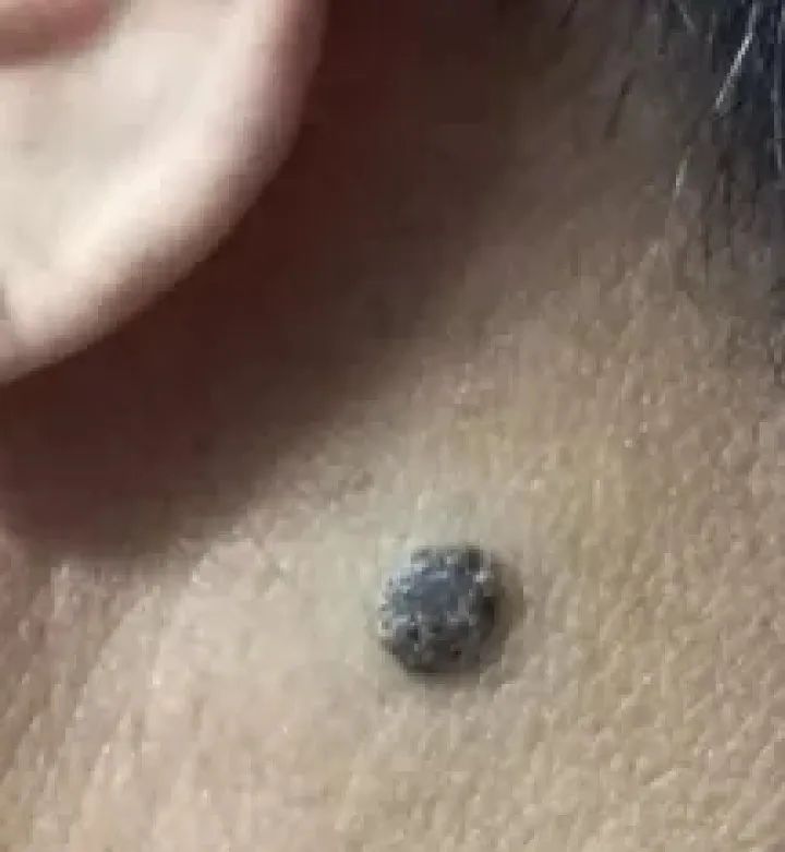 黑痣癌变的10个征兆,黑痣癌变从发病到去世不到两个月