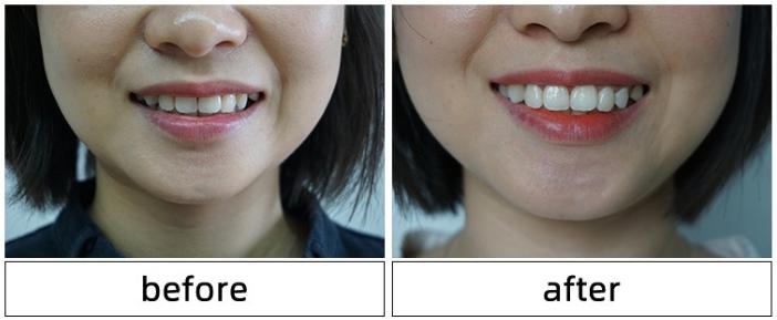 牙齿变黄你真的刷对了吗,牙齿黄了怎么办不用花钱去洗牙