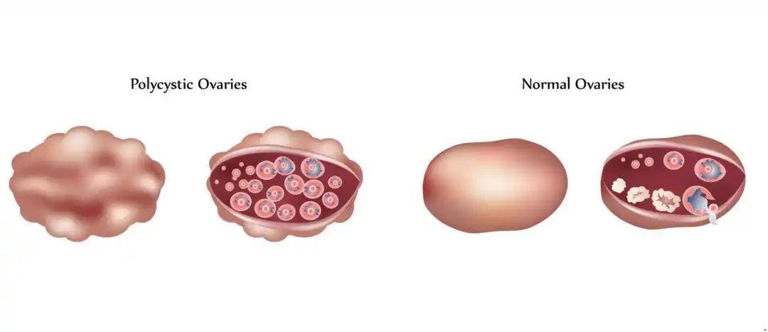 多囊卵巢综合征pcos怎么治疗,多囊卵巢的科普文章