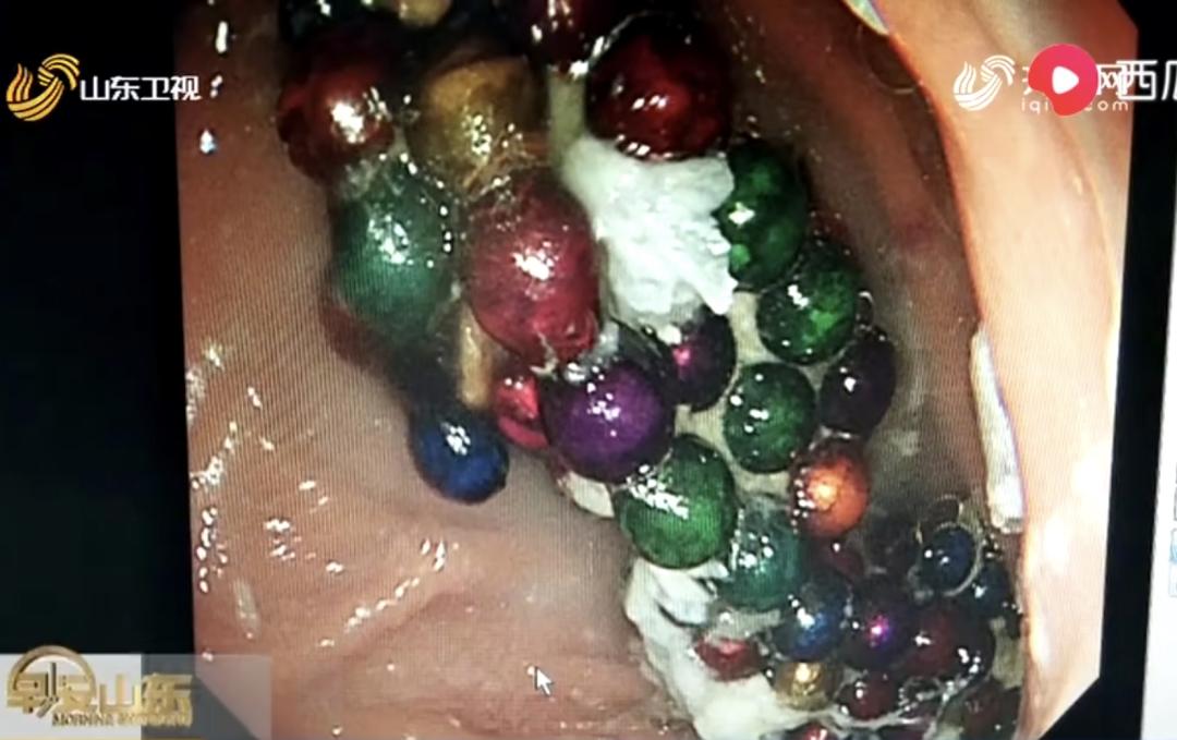 两岁女孩误吞下17颗磁力珠,宝宝吞下四五颗磁力珠怎么办