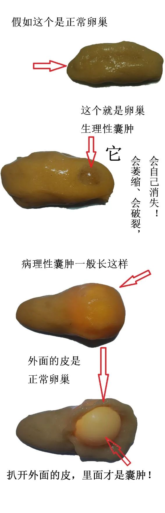 谢娜自曝曾患卵巢囊肿,谢娜多囊卵巢