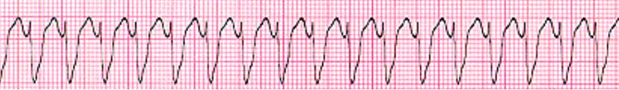 室速全名叫什么,室速的解读和识别