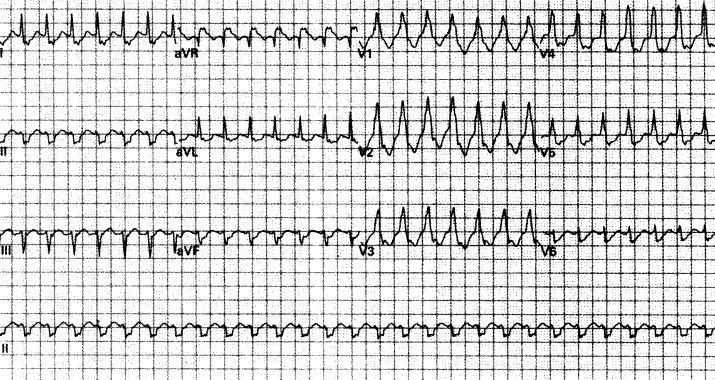 室速全名叫什么,室速的解读和识别