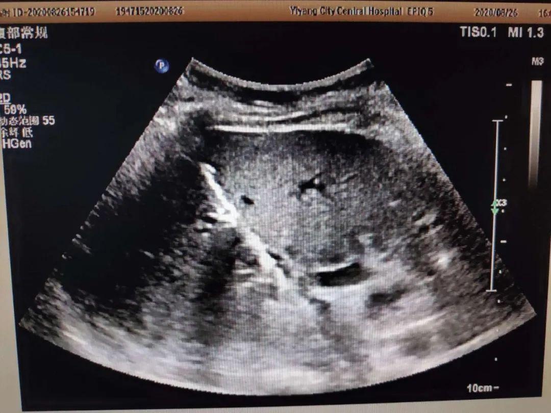 超声介入胆管引流,超声引导下胆道置管引流