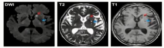 徐运神经内科,徐运医生怎么样
