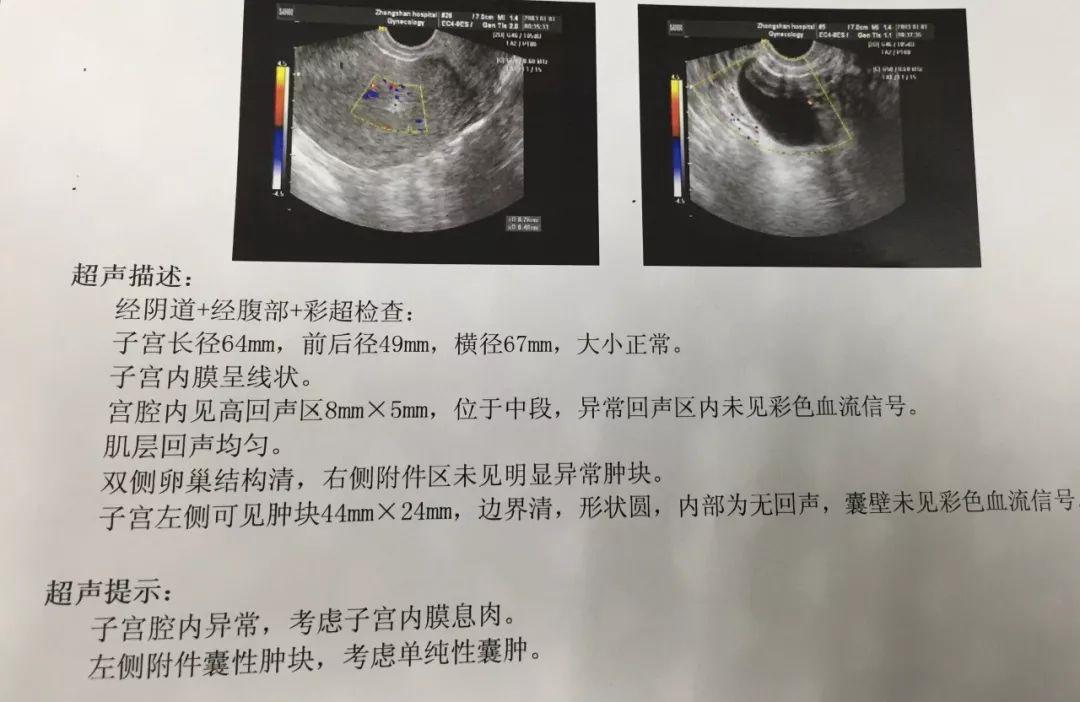 内膜息肉切除后多久怀孕最佳,宫腔内膜中有小息肉会影响怀孕吗