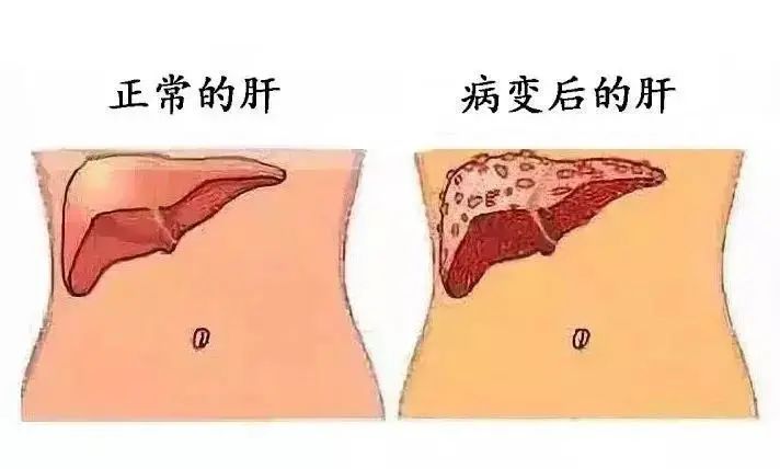 养肝小知识养肝护肝茶要这样喝,养肝护肝茶有科学依据么