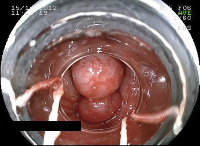 有痔人士的福音内痔的内镜下治疗,胶圈套扎痔疮疗法可以自己做吗