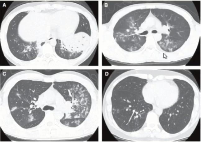 成人肺炎支原体肺炎诊治专家共识,2023肺炎支原体感染中药诊治指南