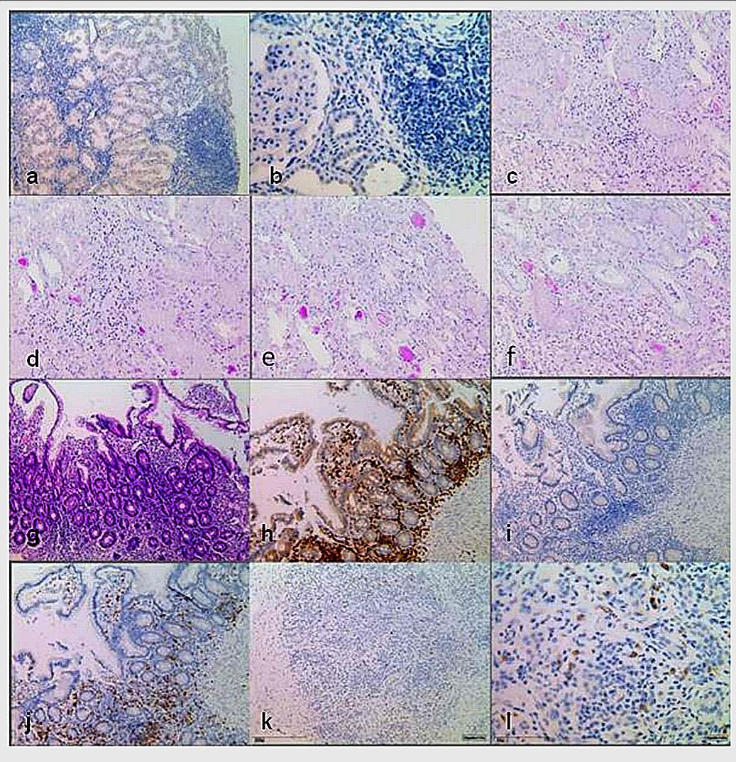 lr858基因突变,lrba基因