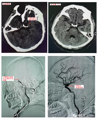 【医疗动态】甘肃省中医院脑病介入科成功拉栓两例高危心源性栓塞患者