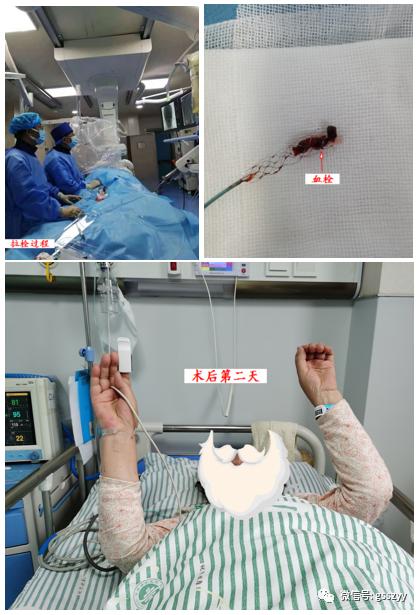 【医疗动态】甘肃省中医院脑病介入科成功拉栓两例高危心源性栓塞患者