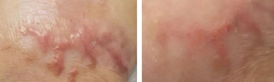 有效淡化疤痕的六个小妙招,贴上疤痕贴也长疤痕