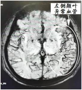 硬脑膜动静脉瘘介入栓塞后的治疗,宣武医院硬脑膜动静脉瘘的治疗
