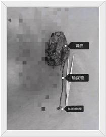 肾盂癌根治术下腹部切口有多大,肾盂癌术后辅助治疗方案