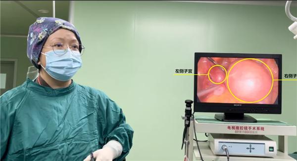 盆腔巨大囊性包块需要手术嘛,盆腔有回声是好事还是坏事