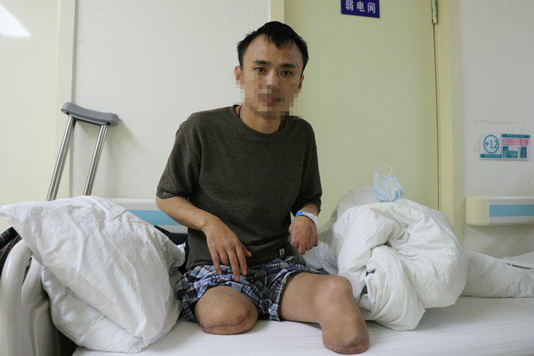 26岁双腿截肢男子,男子截肢靠老婆养家糊口