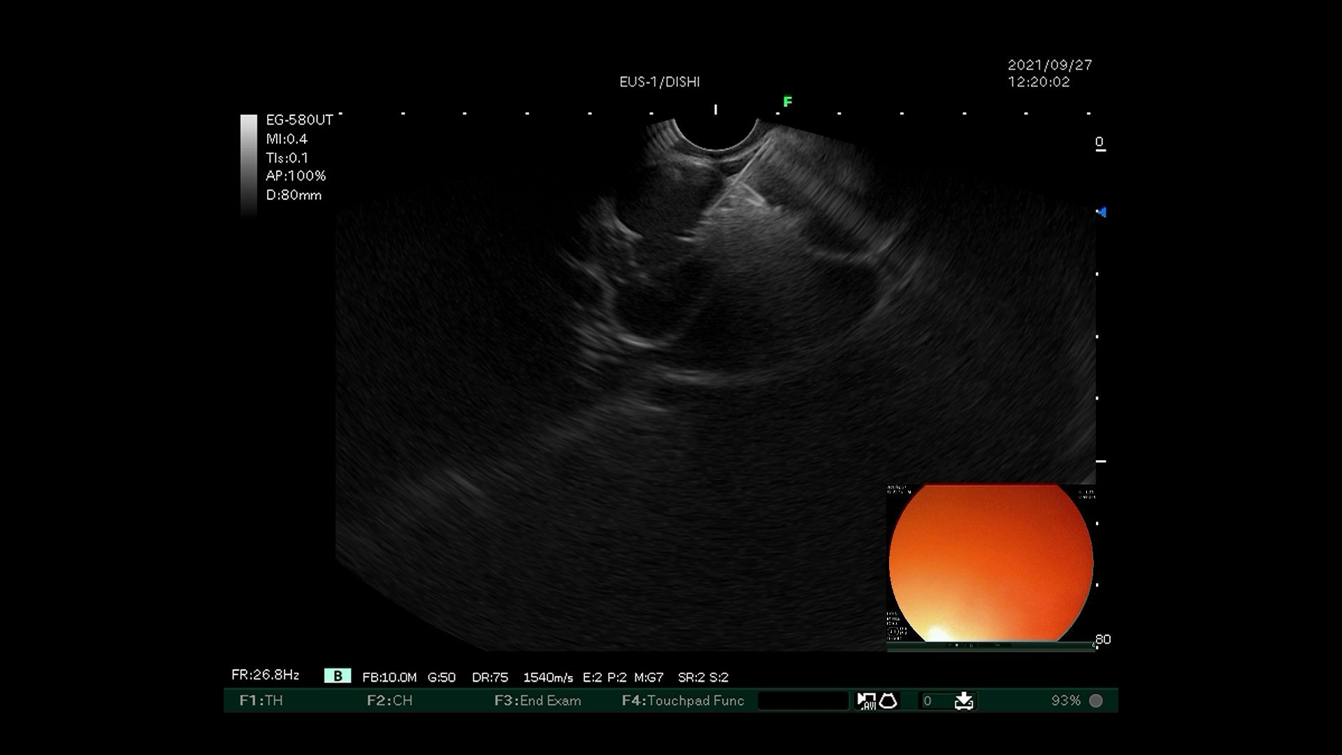 毓璜顶医院国内领先开展超声内镜引导下弹簧圈置入联合组织胶栓塞术治疗伴自发分流的巨大胃底静脉曲张